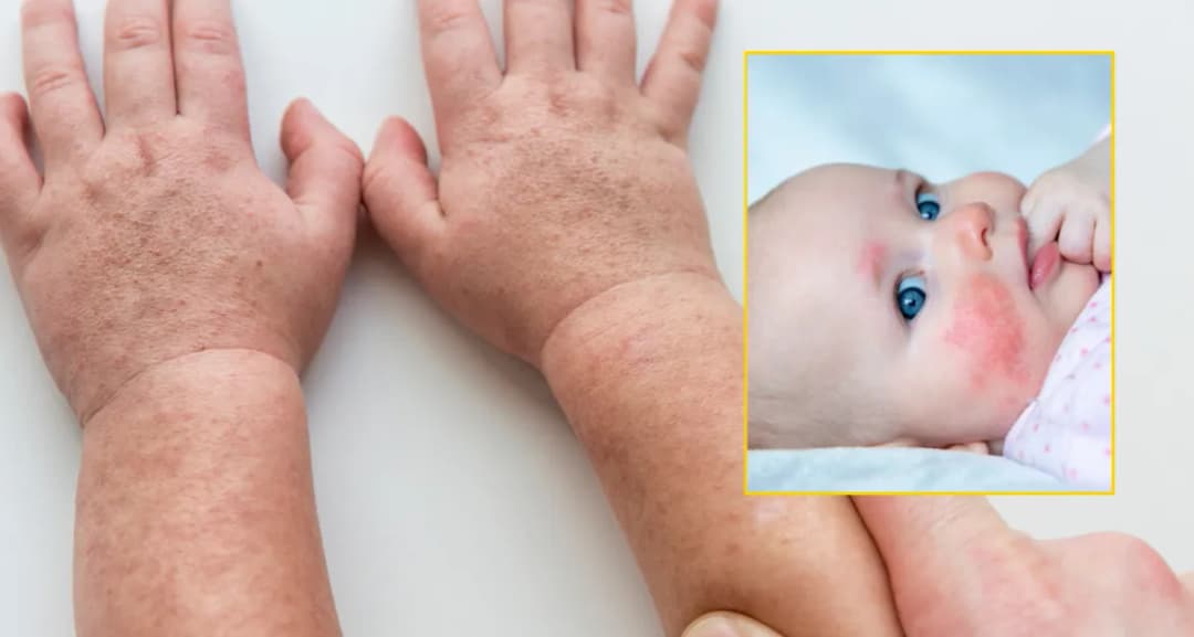 Szkarlatyna: Kąpiel dziecka? Tak, ale z tymi zasadami!