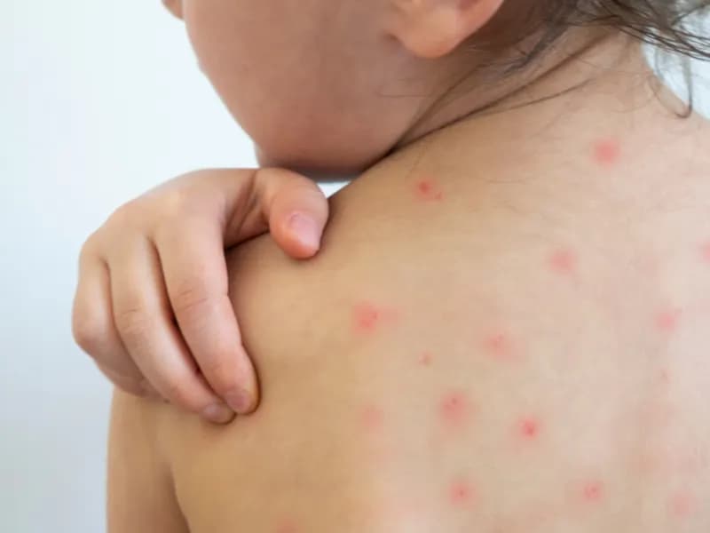 Ospa u dziecka: objawy, leczenie i kiedy do lekarza